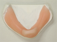 症例１ 審美的・機能的改善した義歯