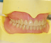 症例１ 審美的・機能的改善した義歯