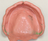 症例１ 審美的・機能的改善した義歯