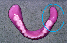 症例２ 下顎左側歯肉癌切除した義歯
